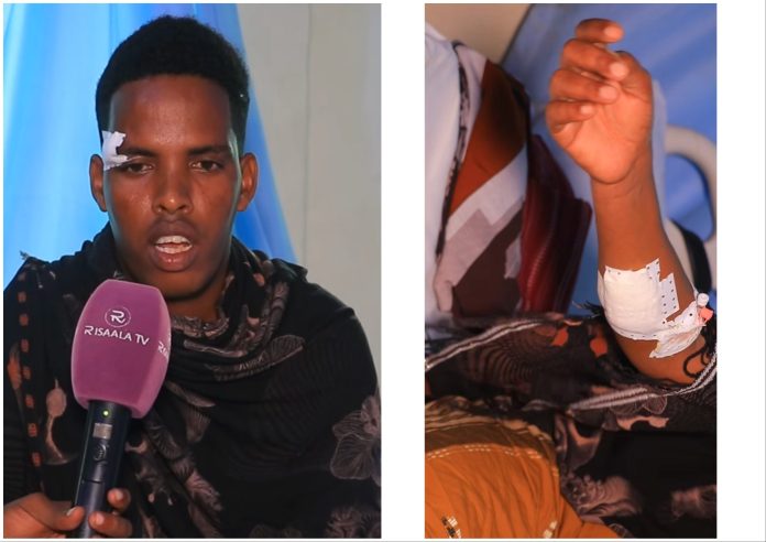 Qaasim Ibrahim Adaan, a news presenter and producer at SMS TV shows his injuries following Liido Beach terror attack on 2 August, 2024. | PHOTO/ Credit/ Risaala TV.